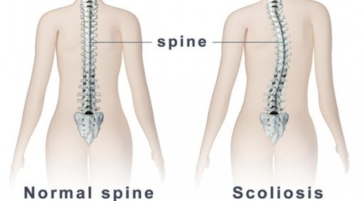 Detail Gambar Penyakit Skoliosis Nomer 48