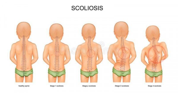 Detail Gambar Penyakit Skoliosis Nomer 49