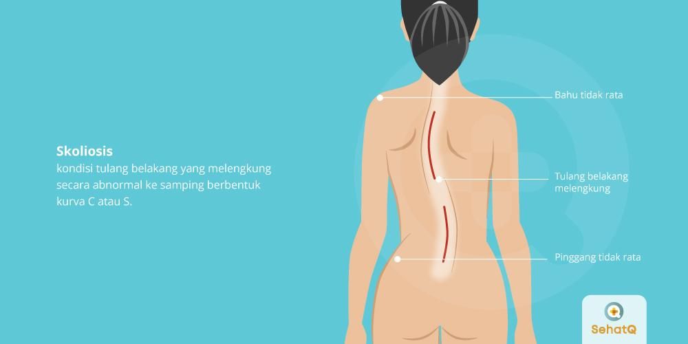 Detail Gambar Penyakit Skoliosis Nomer 8