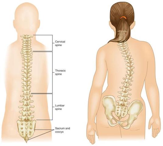 Detail Gambar Penyakit Skoliosis Nomer 9