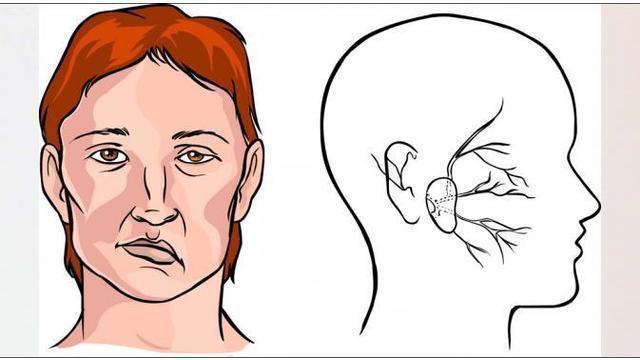 Detail Gambar Penyakit Stroke Nomer 17