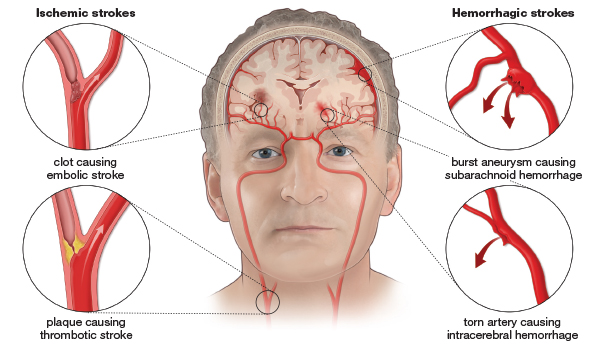 Detail Gambar Penyakit Stroke Nomer 18