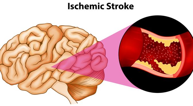 Detail Gambar Penyakit Stroke Nomer 3