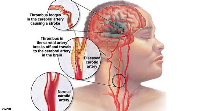 Detail Gambar Penyakit Stroke Nomer 4