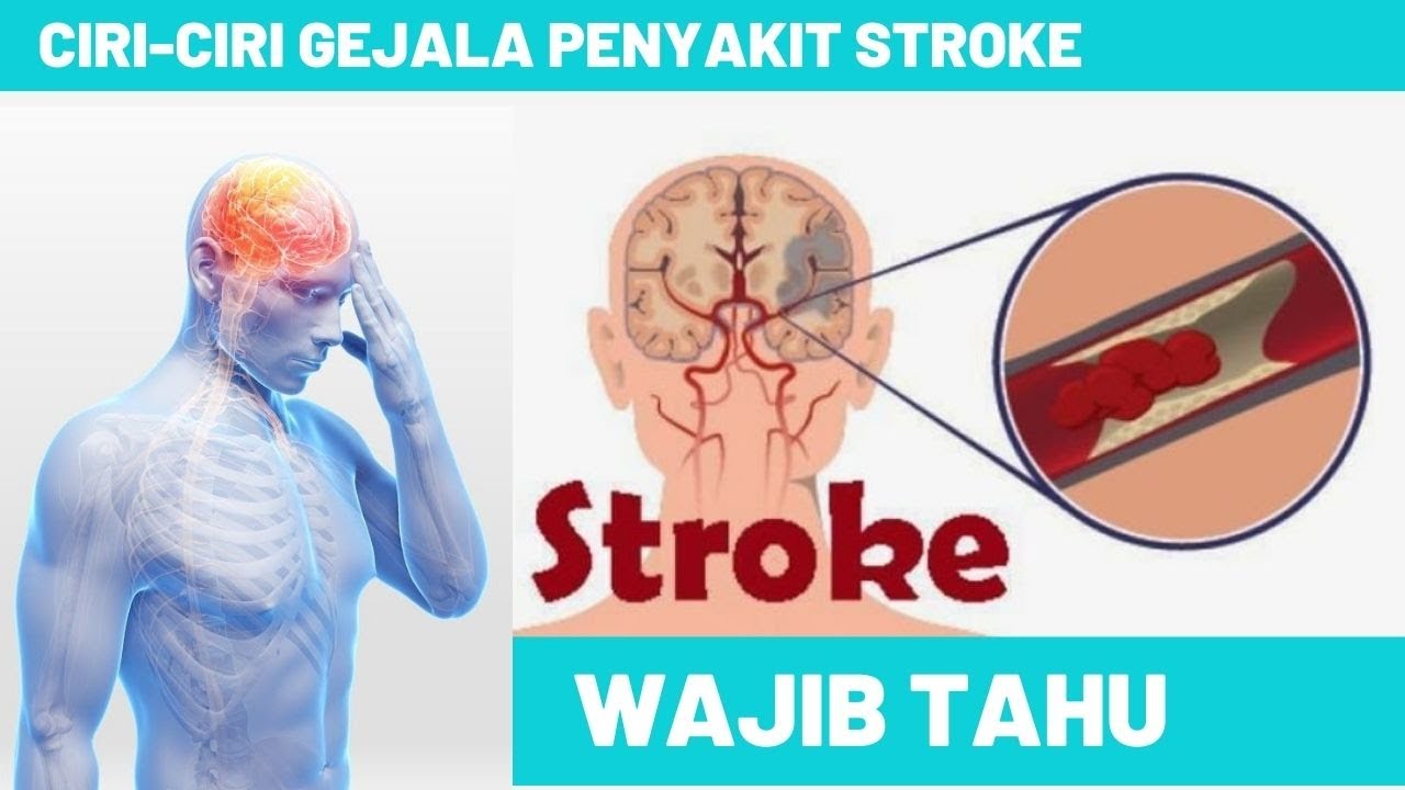 Detail Gambar Penyakit Stroke Nomer 26