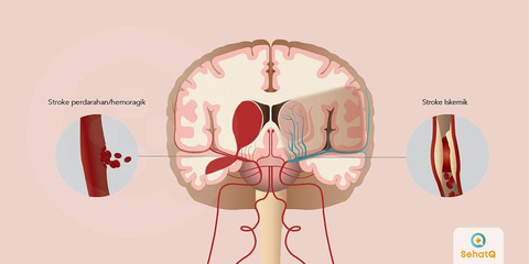 Detail Gambar Penyakit Stroke Nomer 6