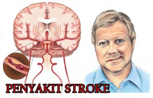 Detail Gambar Penyakit Stroke Nomer 7