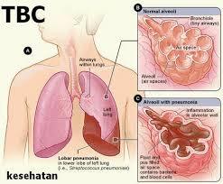 Detail Gambar Penyakit Tbc Nomer 30