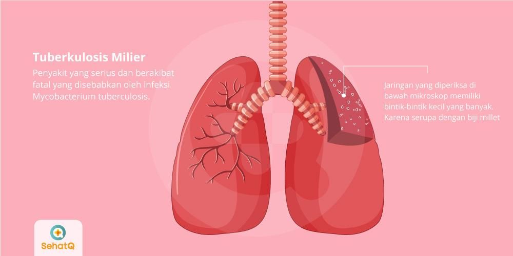 Detail Gambar Penyakit Tbc Nomer 7