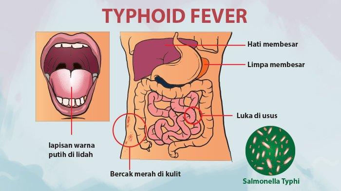 Gambar Penyakit Tipes - KibrisPDR