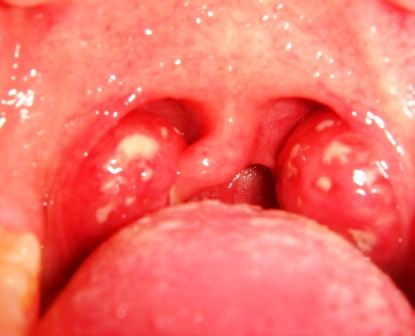 Detail Gambar Penyakit Tonsillitis Nomer 15