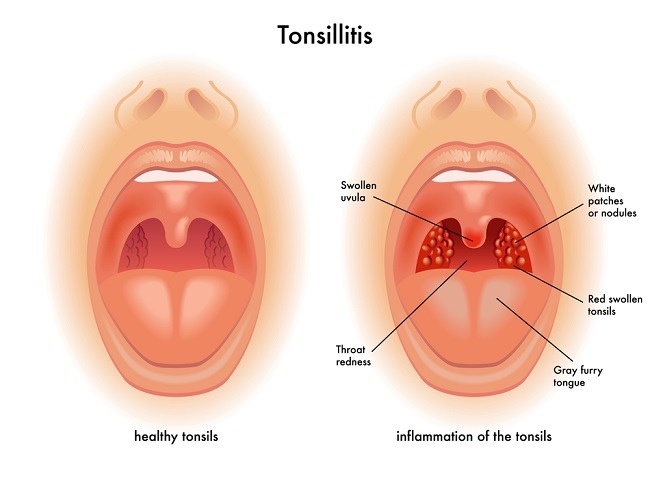 Detail Gambar Penyakit Tonsillitis Nomer 3