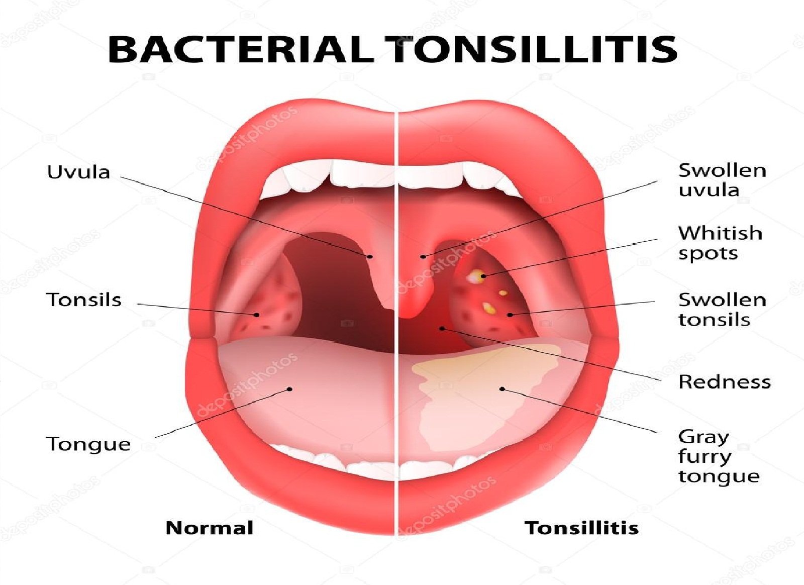 Detail Gambar Penyakit Tonsillitis Nomer 17