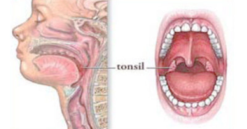 Detail Gambar Penyakit Tonsillitis Nomer 19