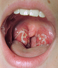 Detail Gambar Penyakit Tonsillitis Nomer 4