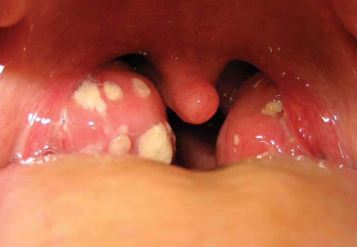 Detail Gambar Penyakit Tonsillitis Nomer 23