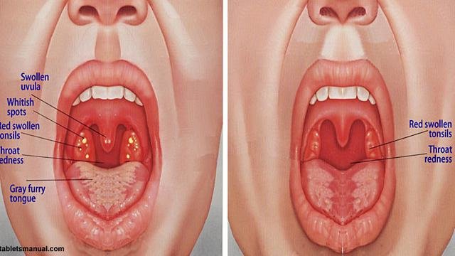 Detail Gambar Penyakit Tonsillitis Nomer 24