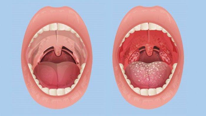 Detail Gambar Penyakit Tonsillitis Nomer 6