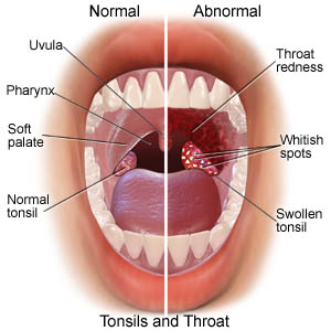 Detail Gambar Penyakit Tonsillitis Nomer 7