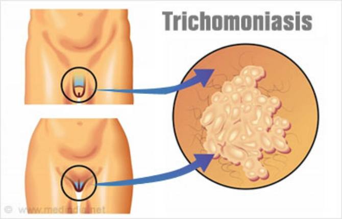 Detail Gambar Penyakit Trikomoniasis Nomer 13