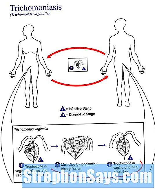Detail Gambar Penyakit Trikomoniasis Nomer 17
