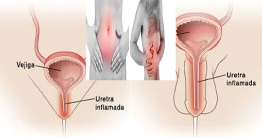 Detail Gambar Penyakit Uretritis Nomer 4