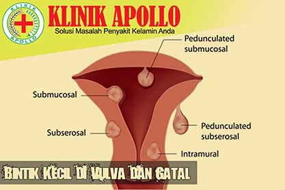 Detail Gambar Penyakit Uretritis Nomer 43