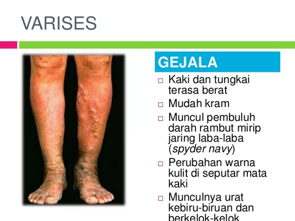 Detail Gambar Penyakit Varises Nomer 35