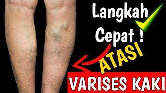 Download Gambar Penyakit Varises Nomer 46