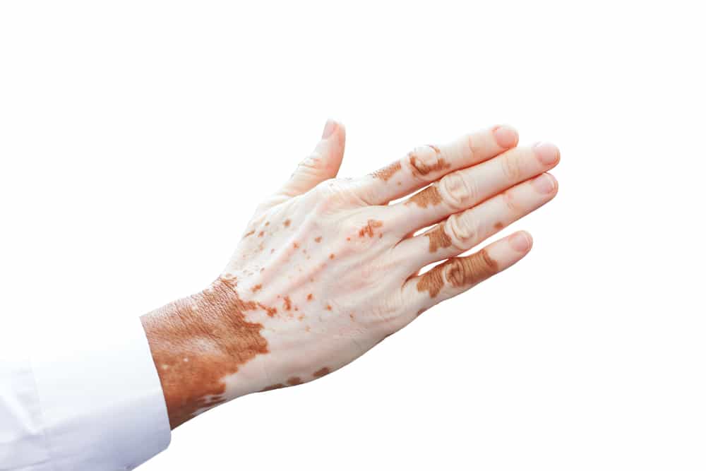 Detail Gambar Penyakit Vitiligo Nomer 2