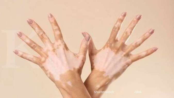 Detail Gambar Penyakit Vitiligo Nomer 16