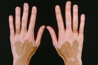 Detail Gambar Penyakit Vitiligo Nomer 24