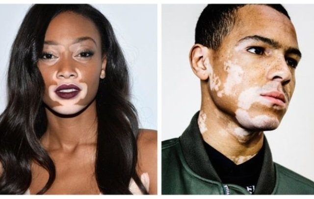 Detail Gambar Penyakit Vitiligo Nomer 5