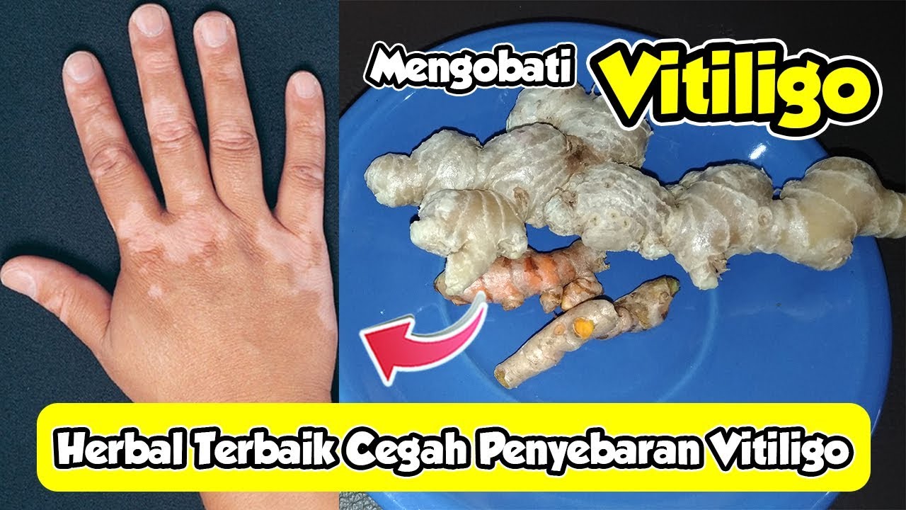 Detail Gambar Penyakit Vitiligo Nomer 46