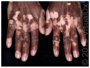 Detail Gambar Penyakit Vitiligo Nomer 56