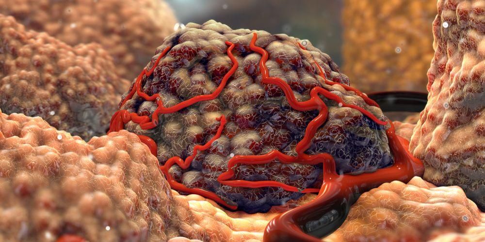 Contoh Tumor Ganas 55 Koleksi Gambar contoh-tumor-ganas-55-koleksi-gambar