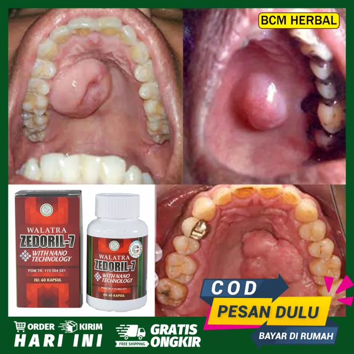 Detail Contoh Tumor Jinak Nomer 44