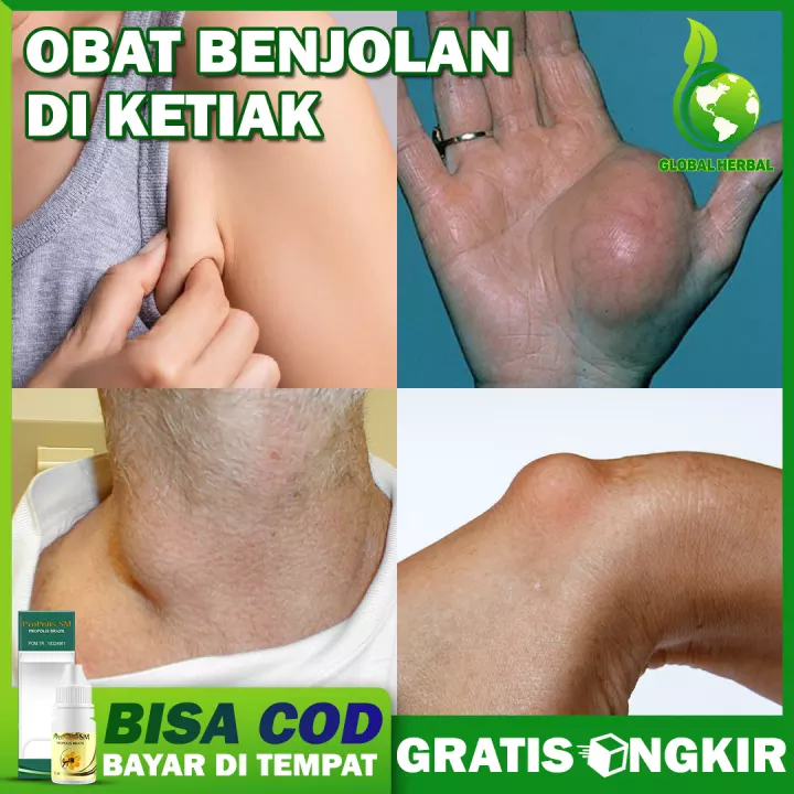 Detail Contoh Tumor Jinak Nomer 54