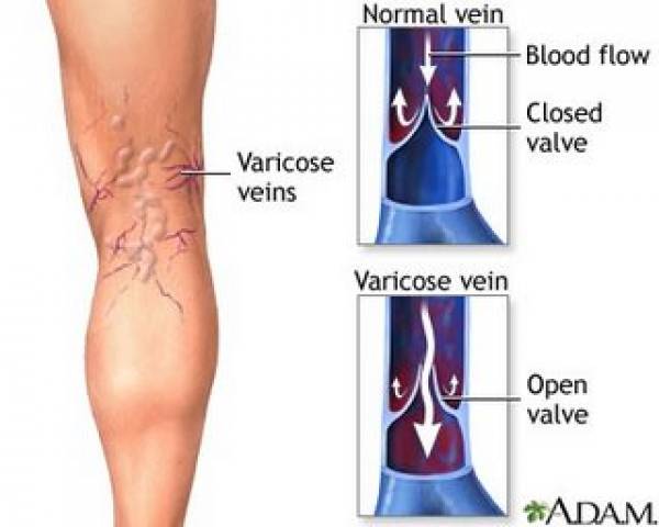 Detail Contoh Varises Kecil Nomer 27