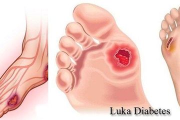 Detail Gambar Perawatan Luka Nomer 45