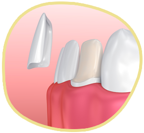 Detail Veneers Bilder Nomer 8