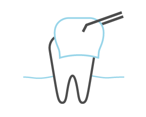 Detail Veneers Bilder Nomer 9