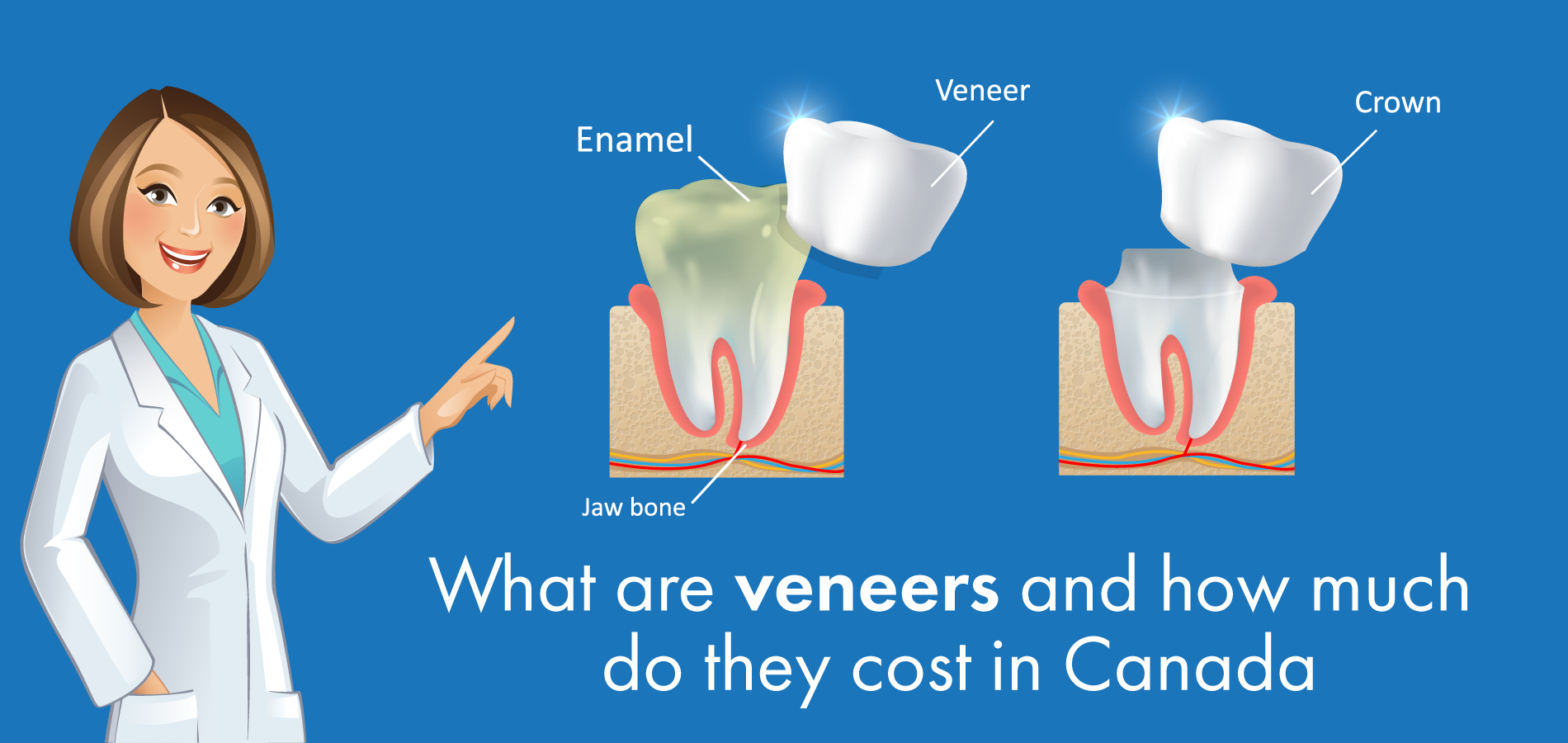 Detail Veneers Bilder Nomer 10
