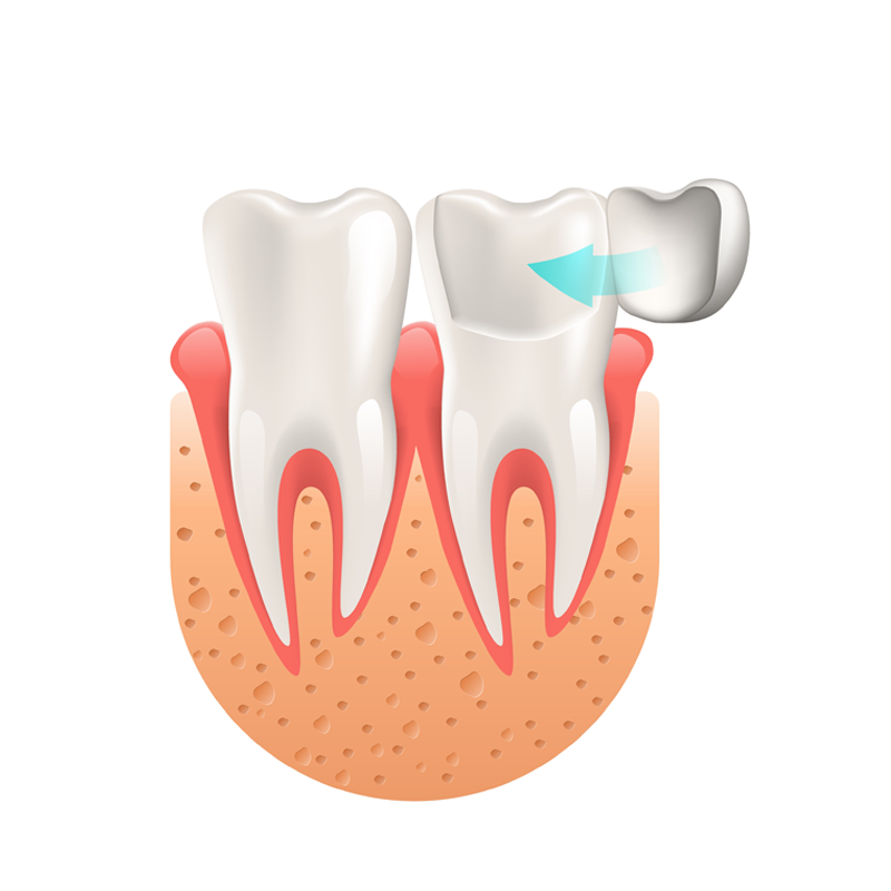 Detail Veneers Bilder Nomer 2