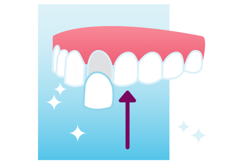 Detail Veneers Bilder Nomer 5