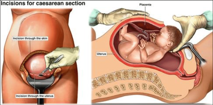 Detail Gambar Perut Saat Operasi Caesar Nomer 20