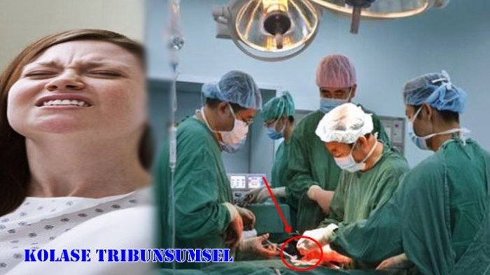 Detail Gambar Perut Saat Operasi Caesar Nomer 37