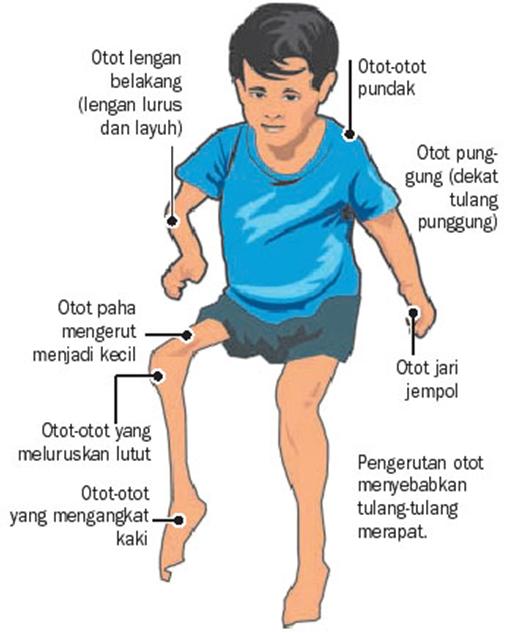 Gambar Polio Pada Anak - KibrisPDR