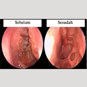 Detail Gambar Polip Hidung Nomer 11