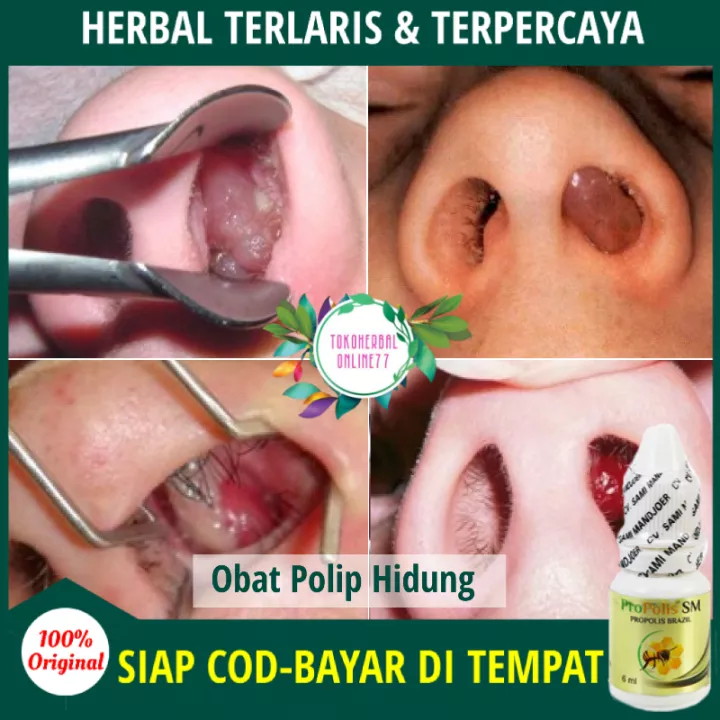 Detail Gambar Polip Hidung Nomer 5